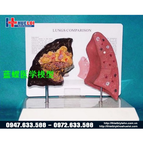 Mô hình Phổi bệnh lý